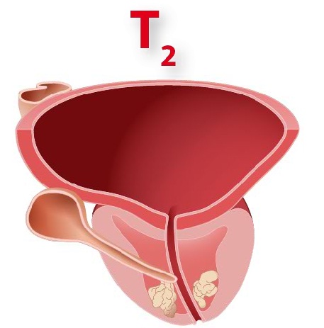  Dgital rektal muayene ile prostat içine sınırlı tümör